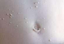 หูดข้าวสุก เจ้าตัวเล็กติดได้ง่ายถ้าไม่ป้องกัน